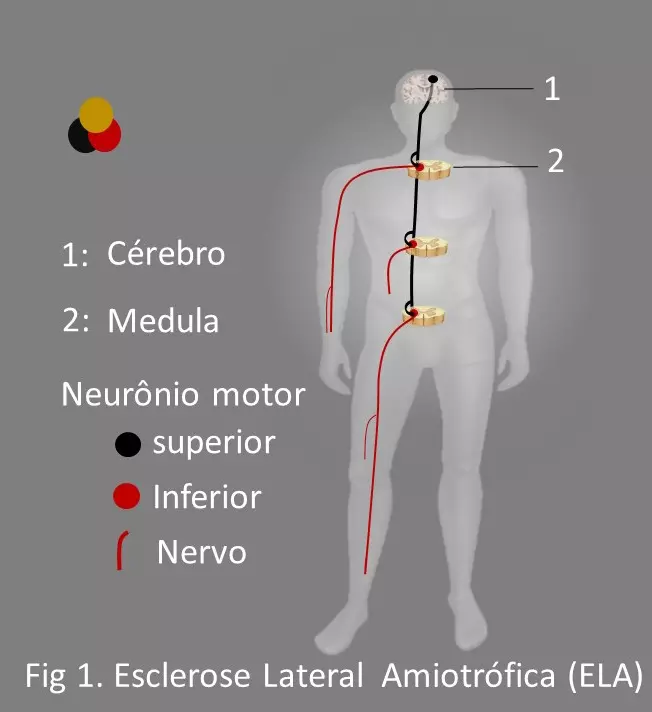 Esclerose Lateral Amiotrófica (ELA) ou Doença dos Neurônios Motores